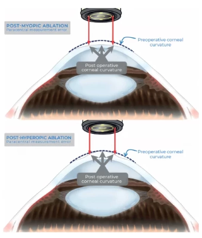 After myopic ablation, the paracentral measurement
will overestimate central corneal power (top), and, after hyperopic
ablation, it will underestimate central corneal power
(bottom)