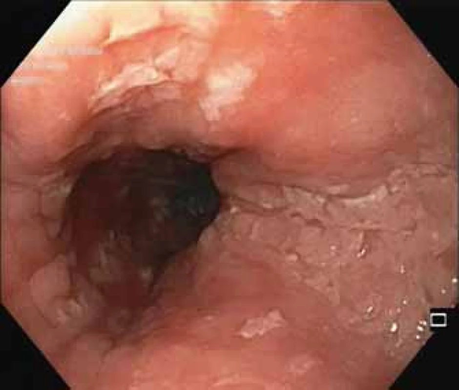 Endoskopický obraz
exfoliativní ezofagitidy.<br>
Fig. 1. Endoscopic image of exfoliative
oesophagitis.