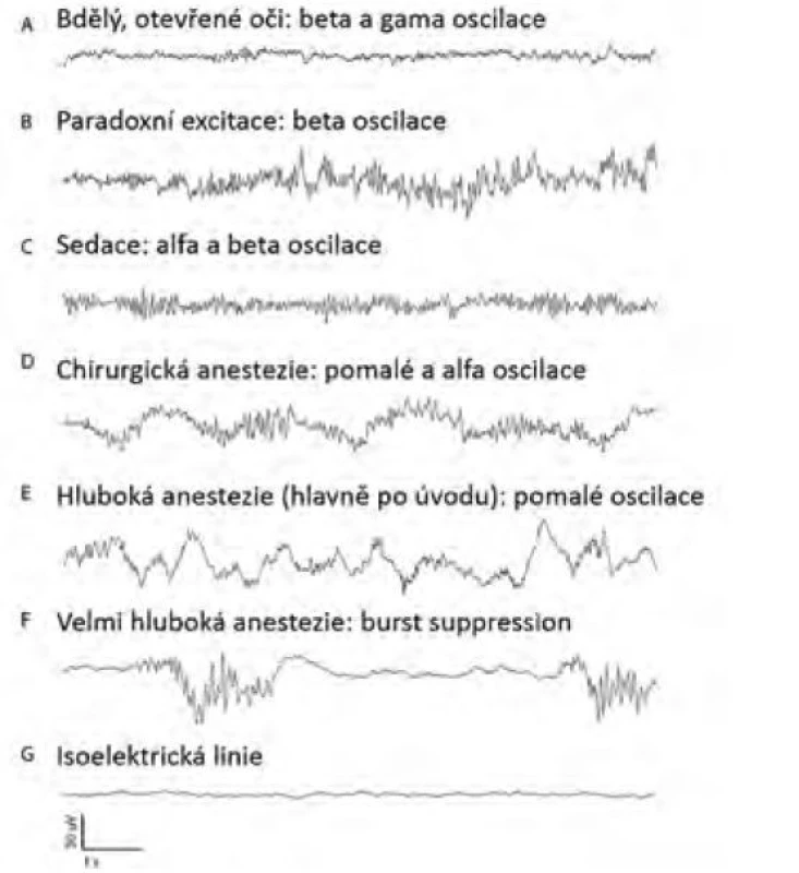Syrové EEG křivky v anestezii propofolem. Amplituda křivek v
anestezii se při srovnání s křivkou bdělého jedince postupně zvyšuje, kdežto
frekvence oscilací s hloubkou anestezie klesá, objevuje se burst suppression
a nakonec isoelektrická linie. Upraveno z [23]