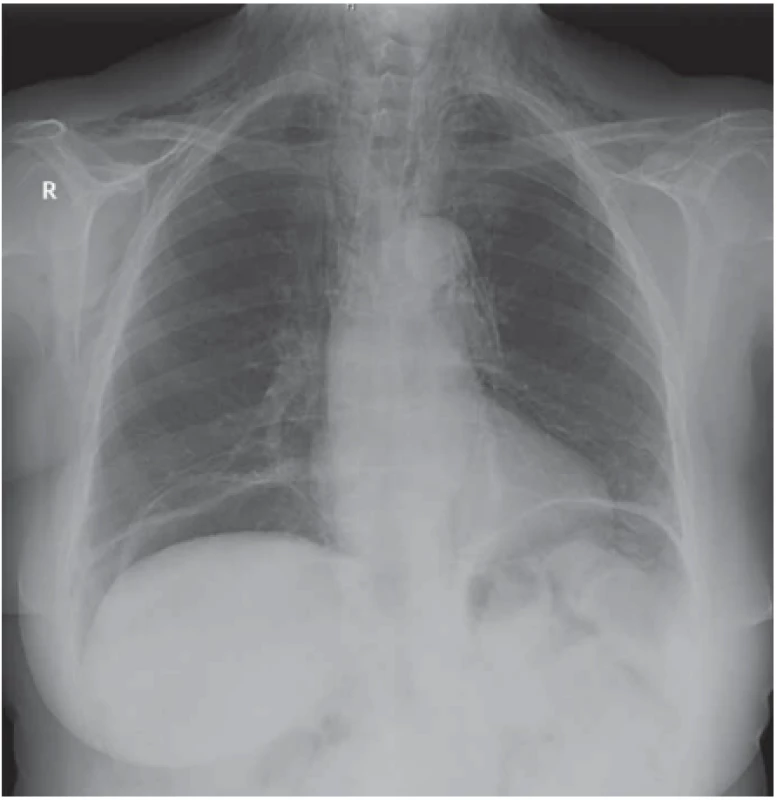 Prostý snímek hrudníku, masivní pneumoperitoneum, oboustranné
podbrániční srpkovité kolekce volného plynu – perforovaný vřed žaludku.<br>
Fig. 1. Plain X-ray of the chest, with a massive pneumoperitoneum, and a bilat eral
diaphragm sickle-shaped collection of free gas – perforated gastric ulcer.