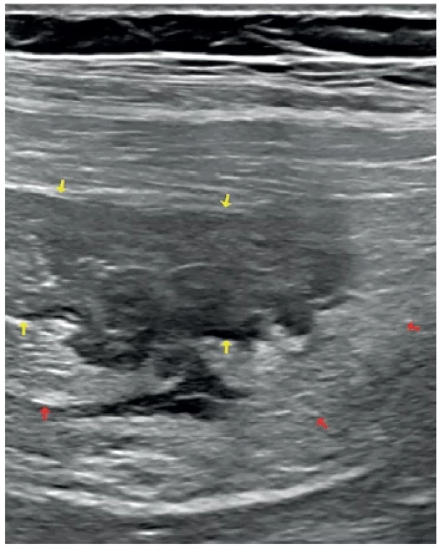 Divertikulitida ilea – ultrazvukové vyšetření břicha,
lineární sonda (12 Hz) <br> 
Fig. 1. Diverticulitis of the ileum – abdominal ultrasound
examination, linear transducer (12 Hz)