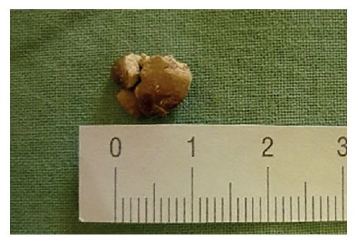 Apendikolit extrahovaný z abscesovej kolekcie<br>
Fig. 3: Appendicolith extracted from the abscess collection