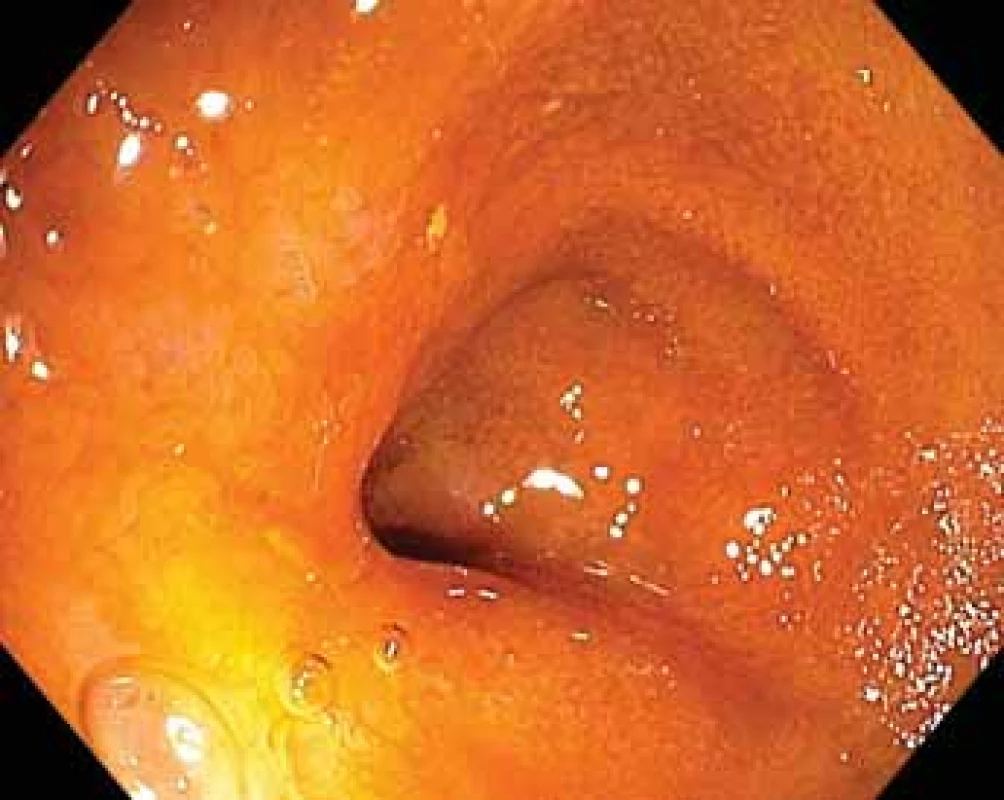 Kontrolní enteroskopie s odstupem 6 měsíců – jizva
po léčbě lymfomu na obr. 4.<br>
Fig. 5. Follow-up enteroscopy in 6 months – scarring after
suc cessful lymphoma treatment (Fig. 4).
