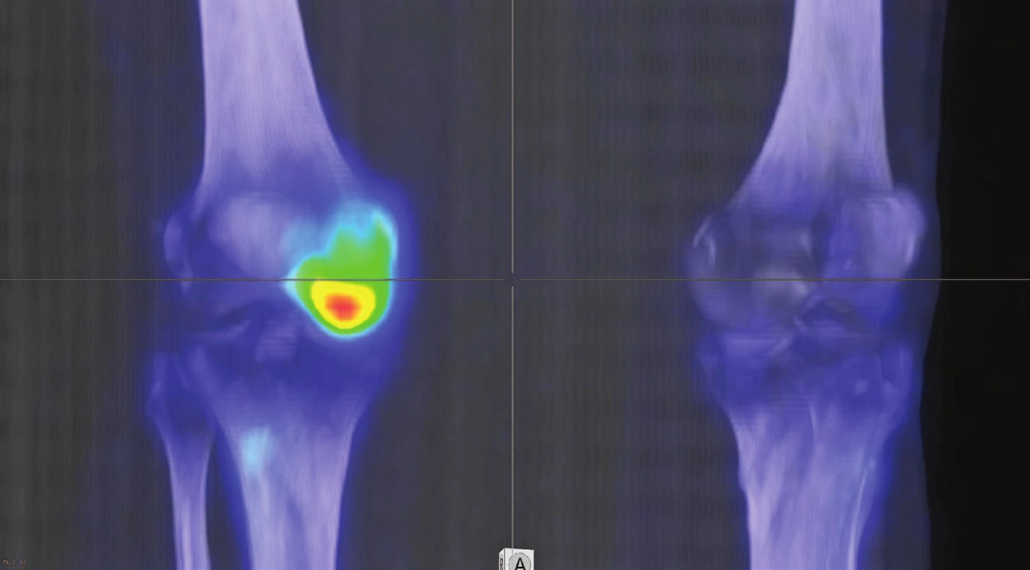 3D rekonstrukce fúzovaného SPECT/CT obrazu u téhož pacienta
s osteonekrózou mediálního kondylu femuru v časném stádiu (I).
