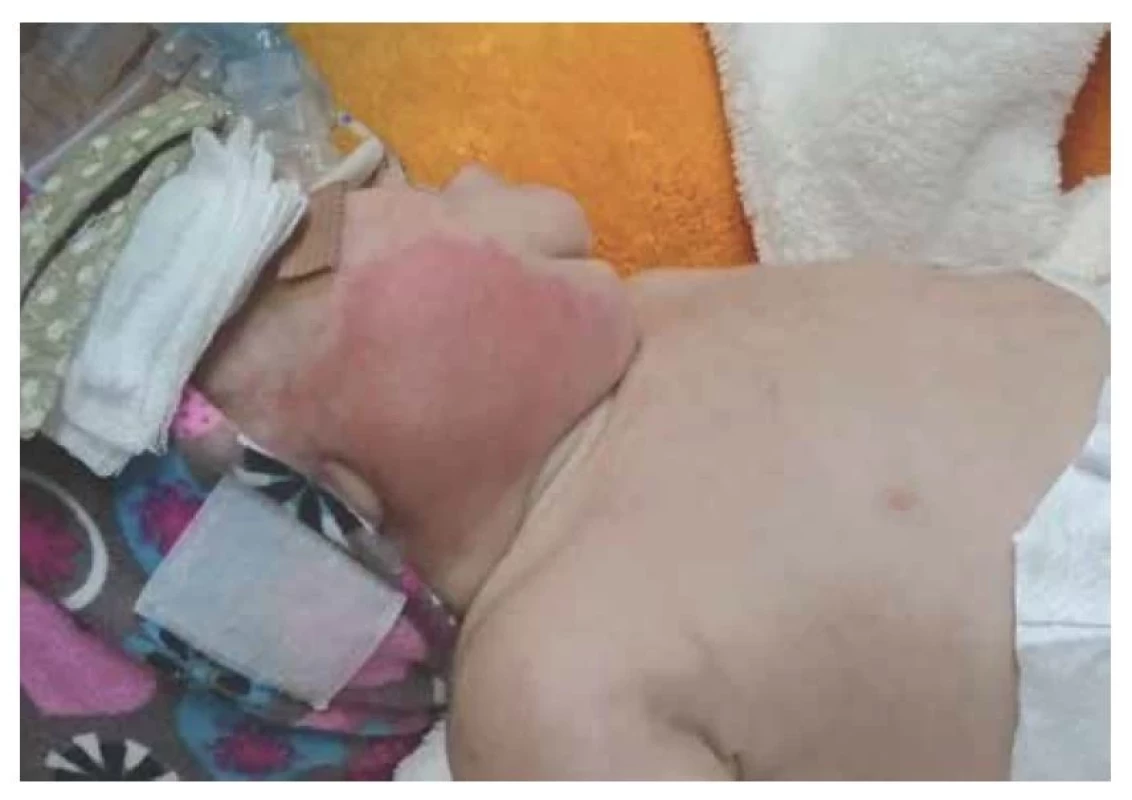 Pozdní GBS sepse a purulentní sialoadenitida u nedonošeného novorozence