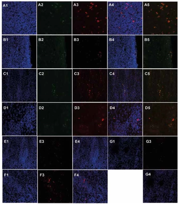 Primary oral keratinocytes and mesenchymal stem cells in post-CED defects 17–36 days after transplantation detected
by confocal microscopy<br>
Fluorescent detection of primary oral keratinocytes (A2, 4, 5, green) and mesenchymal stem cells (A3, 4, 5, red) from pig L139 in
submucosa of the ESD site (A1 – DAPI, A4 merge of A1–3 channels, A5 merge of A2 and A3 channels, 630x magnification). Fluorescent
detection of primary oral keratinocytes (B2, 4, 5, green) and mesenchymal stem cells (B3, 4, 5, red) from pig L139 in cicatricial
mucosa of the ESD site (B1 – DAPI, B4 merge of B1–3 channels, B5 merge of B2 and B3 channels, 630x magnification). Fluorescent
detection of primary oral keratinocytes (C2, 4, 5, green) and mesenchymal stem cells (C3, 4, 5, red) from pig T61 in submucosa of
the ESD site (C1 – DAPI, C4 merge of C1–3 channels, C5 merge of C2 and C3 channels, 630x magnification). Fluorescent detection
of primary oral keratinocytes (D2, 4, 5, green) and mesenchymal stem cells (D3, 4, 5, red) from pig L531 in submucosa of the ESD
site (D1 – DAPI, D4 merge of D1–3 channels, D5 merge of D2 and D3 channels, 630x magnification). Fluorescent detection of
mesenchymal stem cells (E3, 4, red) from pig T79 in submucosa of the ESD site (E1 – DAPI, E4 merge of E1 and E3 channels, 400x
magnification). Fluorescent detection of mesenchymal stem cells (F3, 4, red) from pig T67 in submucosa of the ESD site (F1 – DAPI,
F4 merge of F1 and F3 channels, 400x magnification). Fluorescent detection of mesenchymal stem cells (G3, 4, red) from pig T83 in
submucosa of the ESD site (G1 – DAPI, G4 merge of G1 and G3 channels, 400x magnification).
