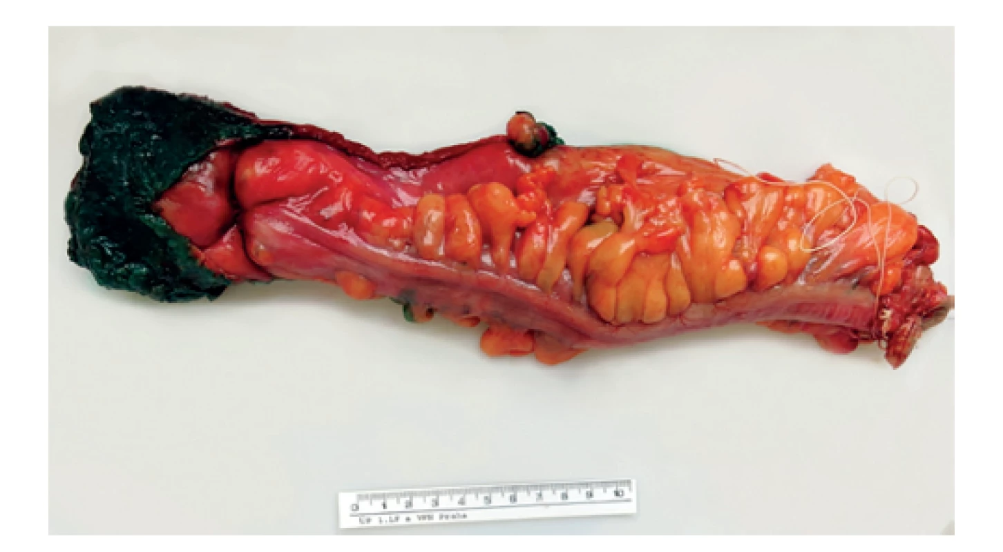 Preparát rekta obarvený tuší<br>
Fig. 3: Specimen of rectum coloured with ink