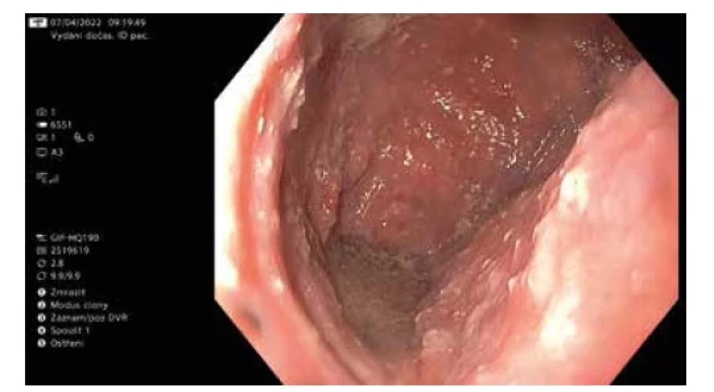 Endoskopický obraz „pseudoachalázie“ s dilatovaným
jícnem, stagnačním obsahem a mykózou sliznice<br>
Fig. 1: Endoscopic image of „pseudoachalasia“ with dilated
esophagus, stagnant contents and mycosis