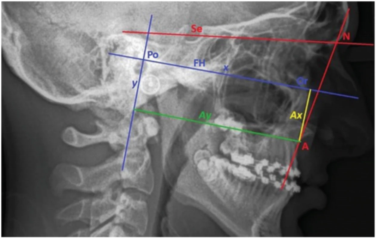 Kefalogram pacienta
s jednostranným celkovým
rozštěpem před Le Fort I
advancement s vyznačenými
kraniometrickými body:
Sella (střed sella turcica),
A (nejzadnější bod na přední
kontuře horního alveolárního
výběžku), Porion (horní okraj
porus acusticus externus;
Po), Orbitale (nejnižší bod
okraje orbity; Or);
a zkonstruovanou
Frankfurskou horizontálou
(linie protínající Po a Or; FH)
a kolmice na ni spuštěná
z bodu Po (Y). Na všech
telerentgenech byl hodnocen
úhel SNA a pozice bodu A
vertikální AX a sagitální AY.<br>
Fig. 3
Cephalogram of patient with
unilateral cleft lip and palate
before Le fort I advancement
with market out cephalometric
points: Sella (in the middle of
sella turcica), A (most dorsal
point at the front contour of
upper alveolar processus),
Porion (upper margin of
porus acusticus externus; Po),
Orbitale (lower point of orbital
margin; Or); and constructed
Frankfort horizontal (line
crossed Po and Or points; FH)
and perpendicular to FH from
Po point (Y). SNA angle, verical
(AX) and sagital (AY) position of
A point were measured at each
cephalogram.