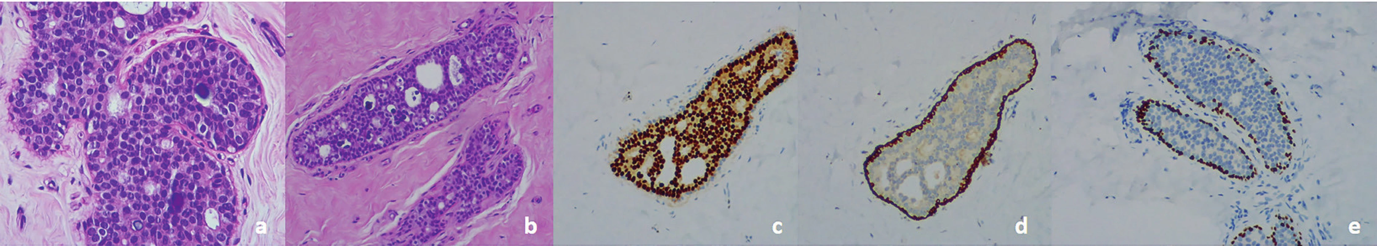 a) Histology. Low-grade DCIS, cribriform, H&E staining. b) Note the presence of a duct filled by cells with the characteristics of low-grade DCIS next to a normal duct. Absence of necrosis and mitosis, H&E staining.<br>
c) Low-grade DCIS. Uniform staining of neoplastic cells for estrogen receptors.<br>
d) Low-grade DCIS. Myoepithelial cells positive for cytokeratin 5 Note negativity for this marker inside the duct.<br>
e) Low-grade DCIS. Myoepithelial cells positive for P63