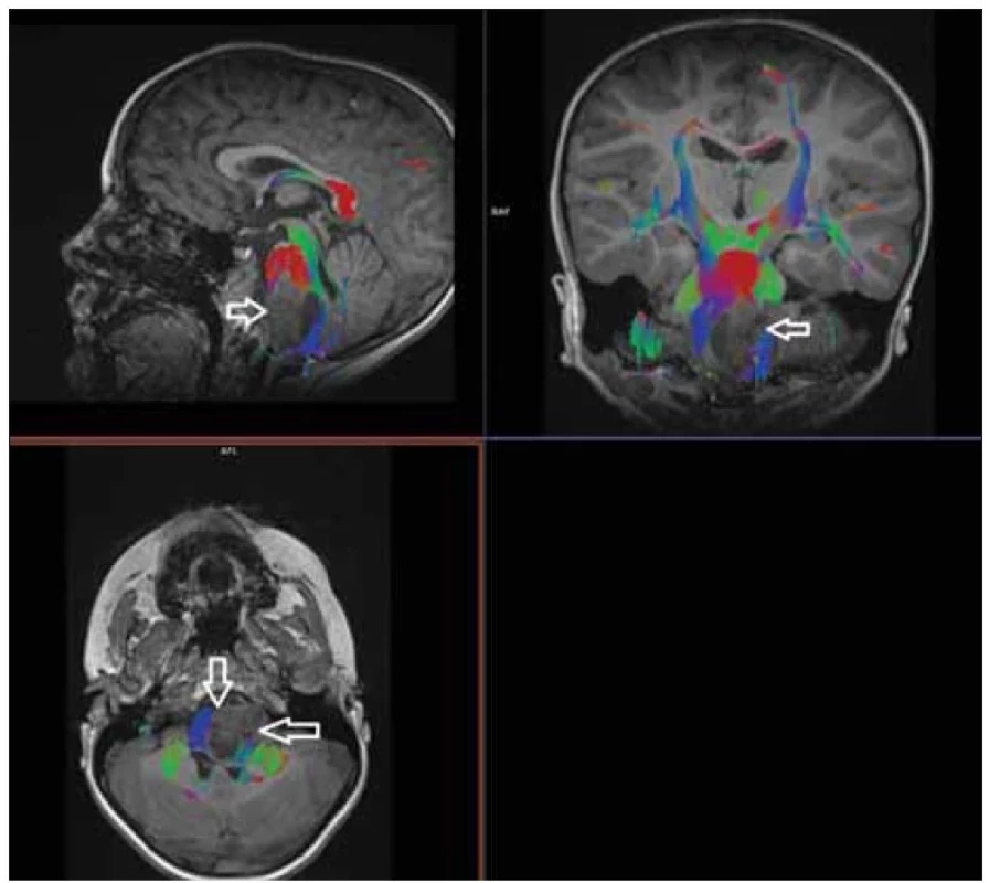 Zobrazení tenzorů difuze ve 3D rekonstrukci s fibretrackingem, pontinní gliom.<br>
Fig. 6. Diffusion tensor imaging in 3D reconstruction with fibre tracking, pontine glioma.