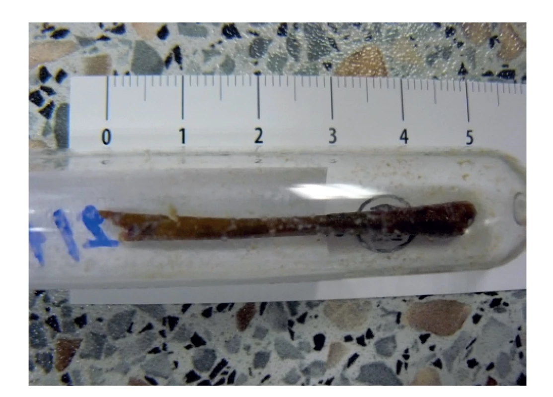 Cizí těleso extrahováné z resekátu<br>
Fig.3: Foreign body extracted from the specimen