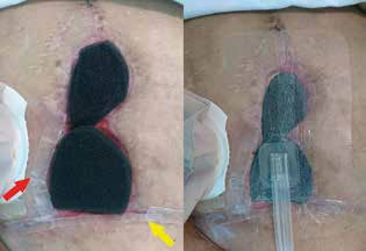 Gelový proužek okolo rány <br>Fig. 10: Gel strip around the wound
