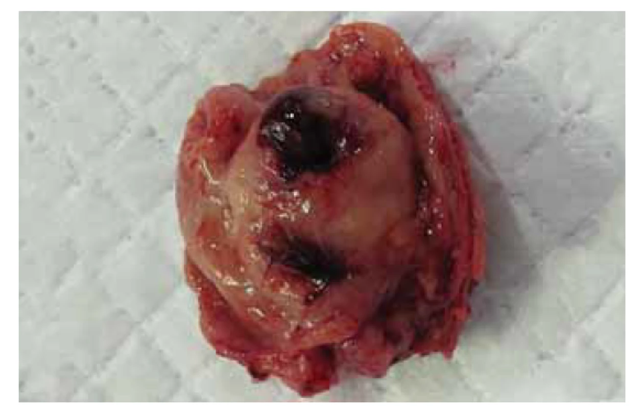 Makroskopický obrázek tumoru z resekátu žaludku.<br>
Fig. 3. Macroscopic image of a tumour from a gastric resection.