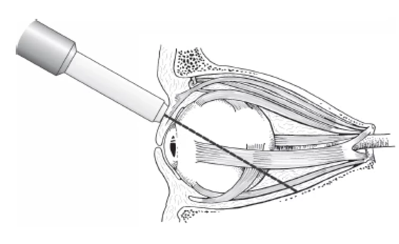 Ultrasound examination of orbit: schematic representation
of transocular method of examination of orbit