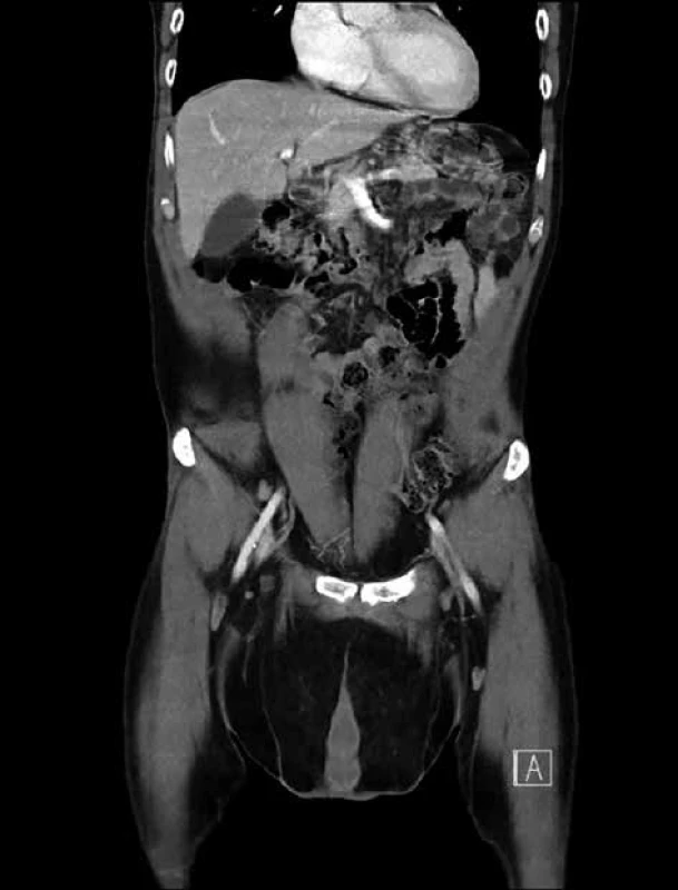 CT − lipomy podbřišku a skrota<br>
Fig. 6: CT − lipomas of the pubic area and scrotum