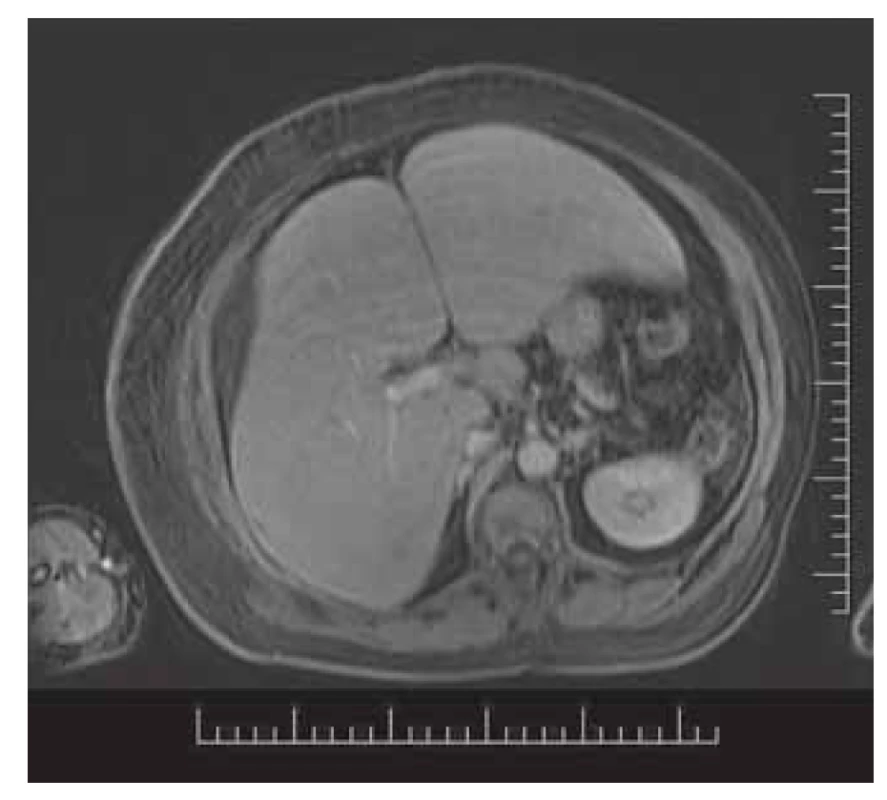 T1-vážený obraz, venózna
fáza, označené viaceré ložiská s
wash-out v pravom aj ľavom laloku,
ascites.<br>
Fig. 5. T1-weighted image, venous
phase, several lesions with washout in
both lobes, ascites.
