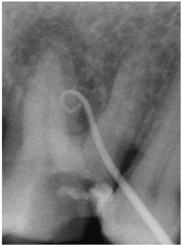 Periapical radiograph