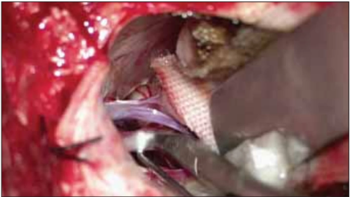 Partial sensory rhizotomy on the trigeminal nerve using
micro-scissors.<br>
Obr. 2. Parciální senzorická rhizotomie trojklanného nervu pomocí mikronůžek. 

