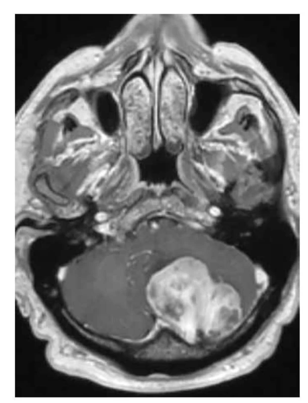 Solitární fibrózní tumor T1W+kontrast: intenzivní sycení tumoru
zadní jámy lební, s výpadky sycení v kalcifikovaných částech, infiltrace přes
duru do diploe kalvy.