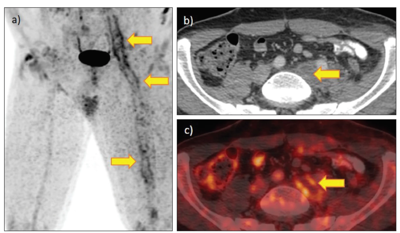 FDG PET/CT u extenzivní subakutní ileofemorální flebotrombózy se zvýšenou akumulací. 52letý pacient s protrahovanou
elevací zánětlivých markerů po komplikované myokarditidě. Synchronní plicní embolie verifikovaná angioCT byla bez akumulace
FDG: a) MIP se zvýšenou akumulací v průběhu hlubokých žil PDK, b) CT s trombem ve v. iliaca communis sin., c) fúze PET/CT se zvýšenou
akumulací v žilní stěně.