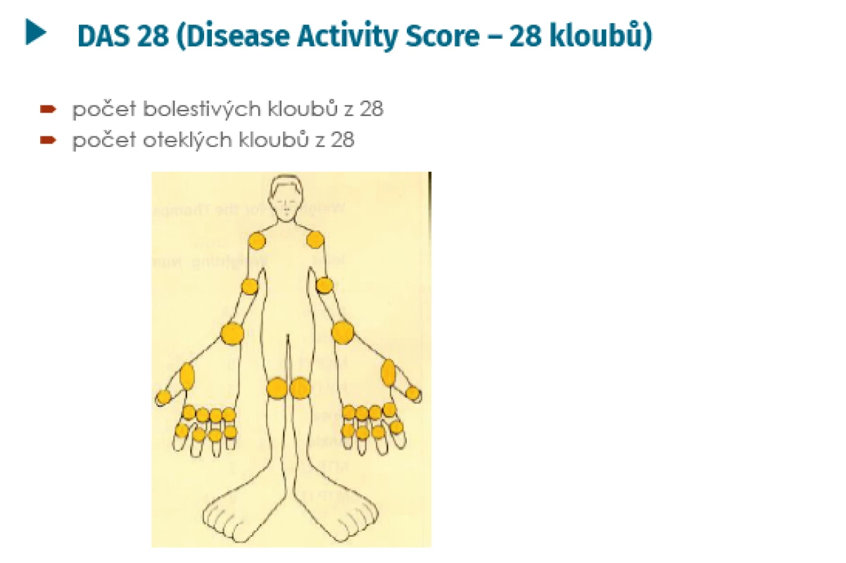 DAS 28 – hodnocené klouby (Aletaha D, Smolen J. Clin
Exp Rheumatol 2005; 23(Suppl 39): 100–108 a Aletaha D,
Ward MM, et al. Arthritis Rheum 2005; 52: 2625–2636)