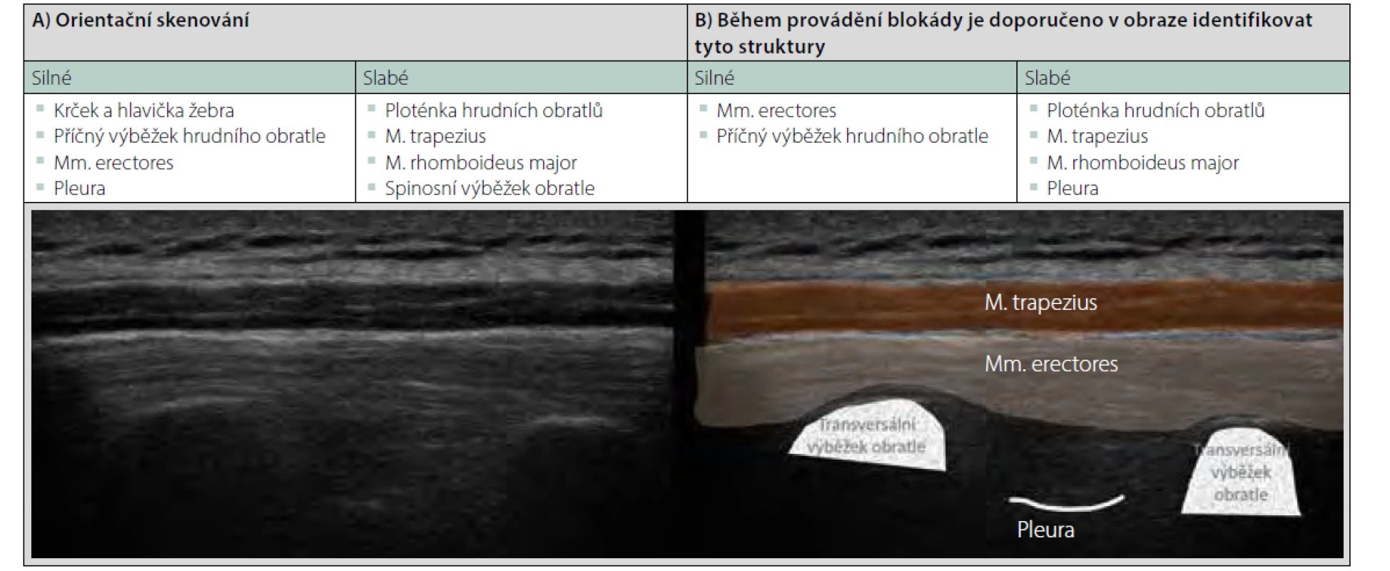 Erector spinae block v hrudní oblasti