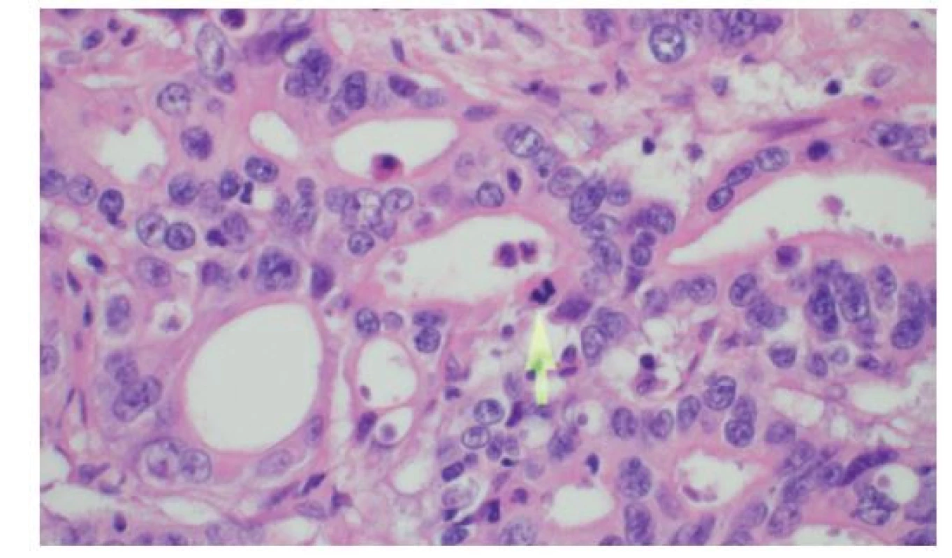 Detail histologie cholangiocelulárního adenokarcinomu
žlučovodu sestávajícího z anastomózujících tubulárních
žlázek<br>
Šipka označuje mitózu, HE, 600×<br>
Fig. 5: Histology of bile duct cholangiocellular adenocarcinoma
consisting of anastomosing tubular glands<br>
The arrow shows the mitotic figure, HE, 600×.