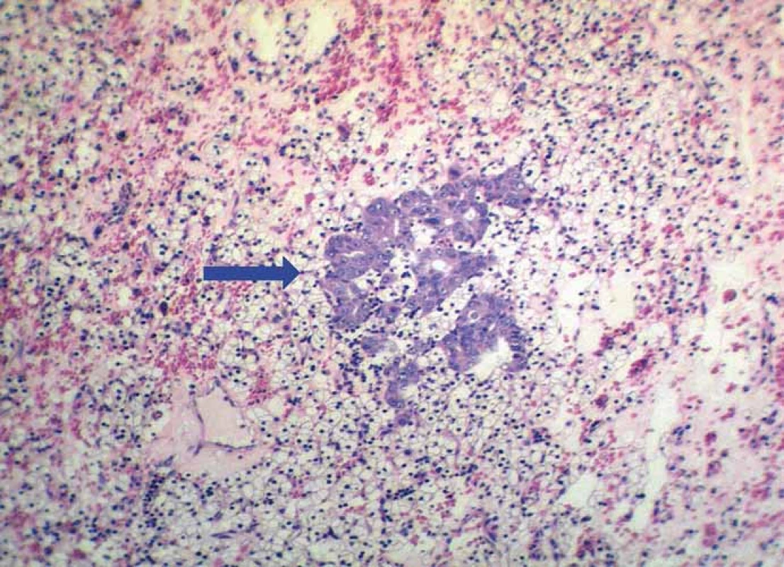 Small focus of metastatic adenocarcinoma (blue arrow) on the background of
clear cell RCC. Metastasis exhibits a typical glandular pattern (hematoxylin & eosin,
magnifi cation 200×).
