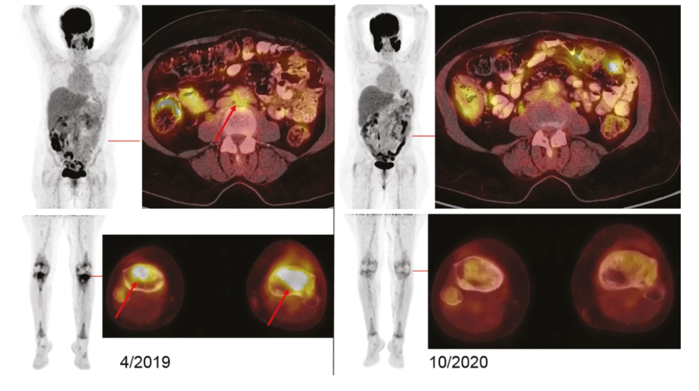 Vizualizace nemoci pomocí FDG-PET/CT vyšetření: Vlevo iniciální sken s MIP projekcí trupu a dolních končetin (v černobílé barevné škále). Červeně
jsou označeny axiální fúzované řezy (v barevné škále Hot Body), s detaily FDG-avidního postižení retroperitonea a proximálních tibií (šipky). Vpravo pak
identické oblasti potvrzující remisi (vymizení akumulací FDG v RP i skeletu). U pacientky se opakovaně zobrazují metabolicky aktivní žvýkací svaly – jako
projev svalové aktivity žvýkání bezprostředně před vyšetřením. Akumulace FDG v mozku, ledvinách, močovém měchýři je fyziologická. Akumulace v tračníku
je variantou fyziologického zobrazení