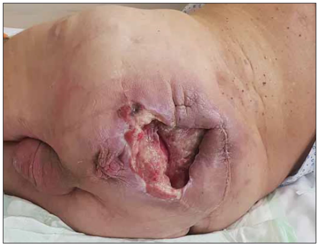 Large and deep pressure ulcer in whole sacral region.<br>
Obr. 1. Rozsáhlý dekubitus postihující prakticky celou oblast sakra
a hýždí.