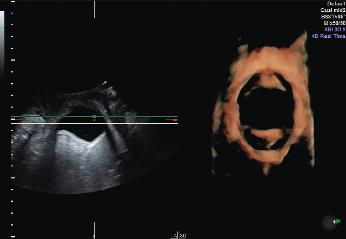 3D rekonstrukce svalů pánevního dna při Valsalvově
manévru a rozšíření urogenitální hiátu (balooning)