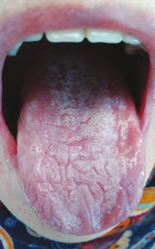 Lichenoidní poléková reakce
na alopurinol
(z archivu autorky)<br>
Fig. 2
Lichenoid drug eruption,
reaction to alopurinol
(author´s archive