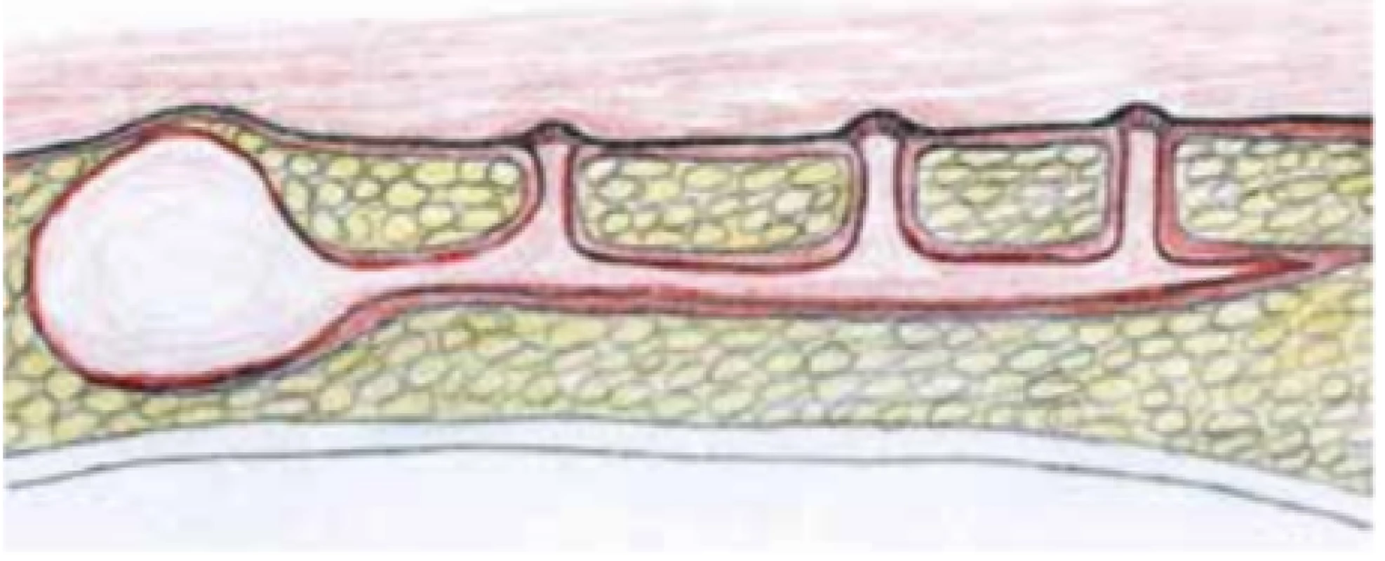 Schematické znázornění pilonidálního sinu<br>
Fig. 4: Schematicviewofpilonidal sinus
https://www.huidziekten.nl/zakboek/dermatosen/stxt/
sinus-pilonidalis.htm