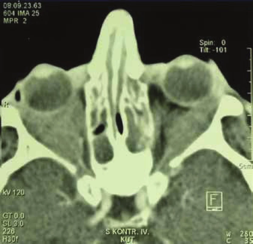 Bilateral pseudotumour of orbits in generalised form of GPA