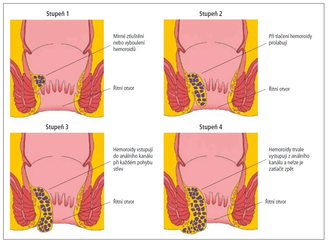 Klasifikace vnitřních hemoroidů. [Upraveno podle: American Society of Colon and Rectal Surgeons’ clinical practice guidelines for the management of
hemorrhoids]