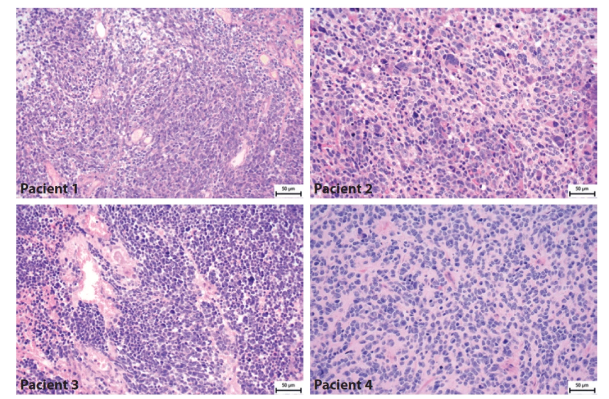 Histologický nález pacientů s meduloblastomem. Pacient 1- Klasický meduloblastom tvořený hustě nakupenými atypickými protáhlými
buňkami s oválnými jádry. Pacient 2 - Velkobuněčný/anaplastický meduloblastom tvoří kromě menších atypických buněk i četné obrovské
buňky s výrazně nepravidelnými jádry. Pacient 3- Velkobuněčný/anaplastický meduloblastom je složený jednak z oblastí vzhledu klasického
meduloblastomu, ale převažují úseky tvořené většími polygonálními buňkami s anaplastickými rysy a s velkými jádry místy s patrnými jadérky.
Pacient 4- Klasický meduloblastom tvořený atypickými protáhlými buňkami, které místy naznačeně tvoří rytmické struktury.