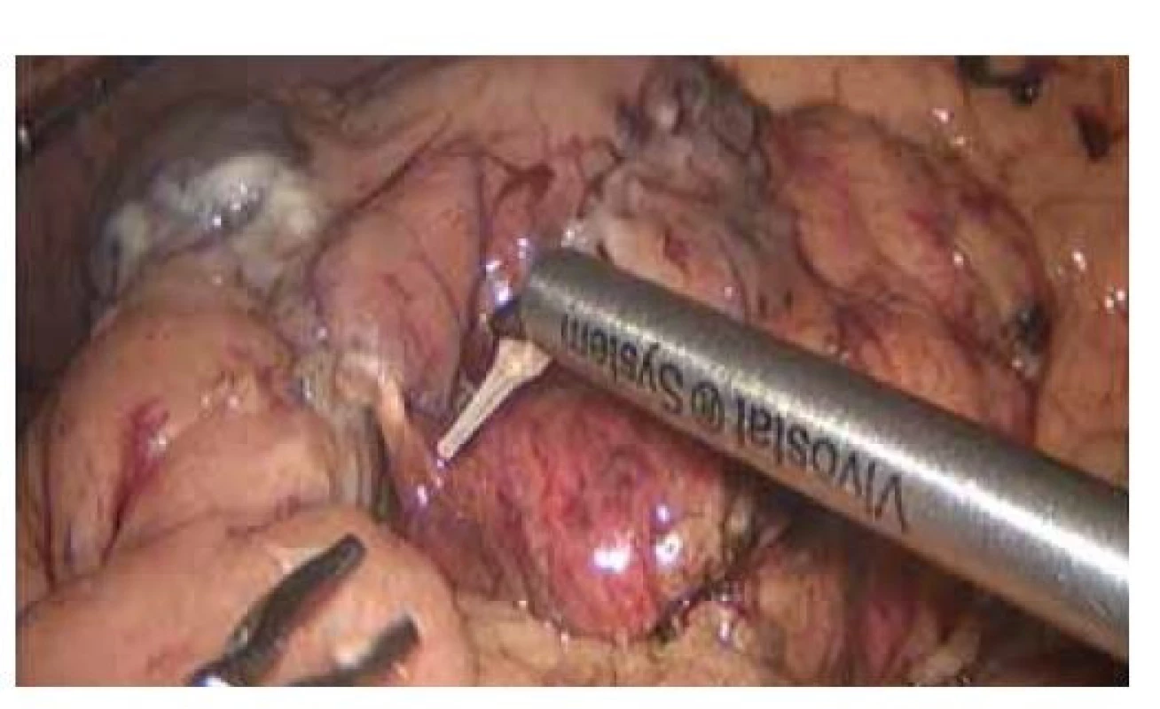 Ošetření resekční linie pankreatu pomocí autologního
tkáňového lepidla Vivostat PRF®.<br>
Fig. 2. Protection of the resection line of the pancreas with
autologous fibrin sealant Vivostat PRF®.