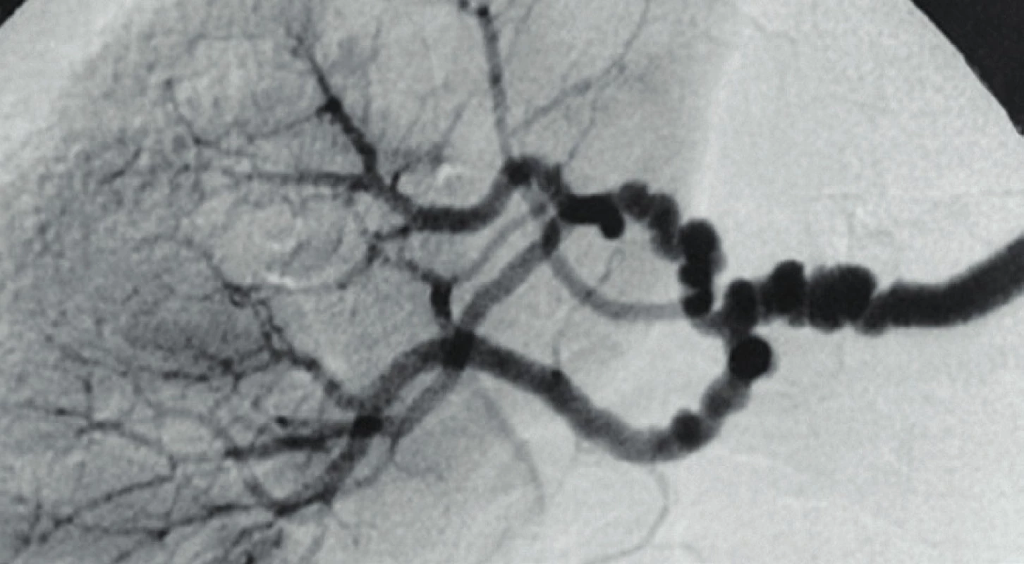 String of beads“ (retiazka korálok) – typický nález
v renálnej artérii [25].<br>
Fig. 7. String of beads – typical findings in renal artery [25].
