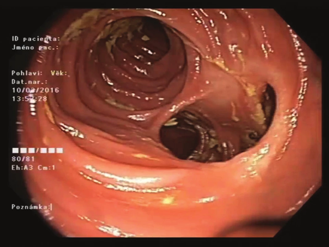 Endoskopický pohled na střevní anastomózu
(12 měsíců po zákroku)<br>
Fig. 2: Endoscopic view of the intestinal anastomosis
(month 12 after the procedure)