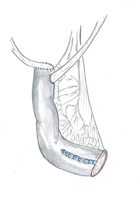Modrá linie znázorňuje novou suturu (retubularizaci) zbylé části původní neoveziky<br>
Fig. 4. The blue line shows a new suture (retubularization) of the remaining part of the neobladder