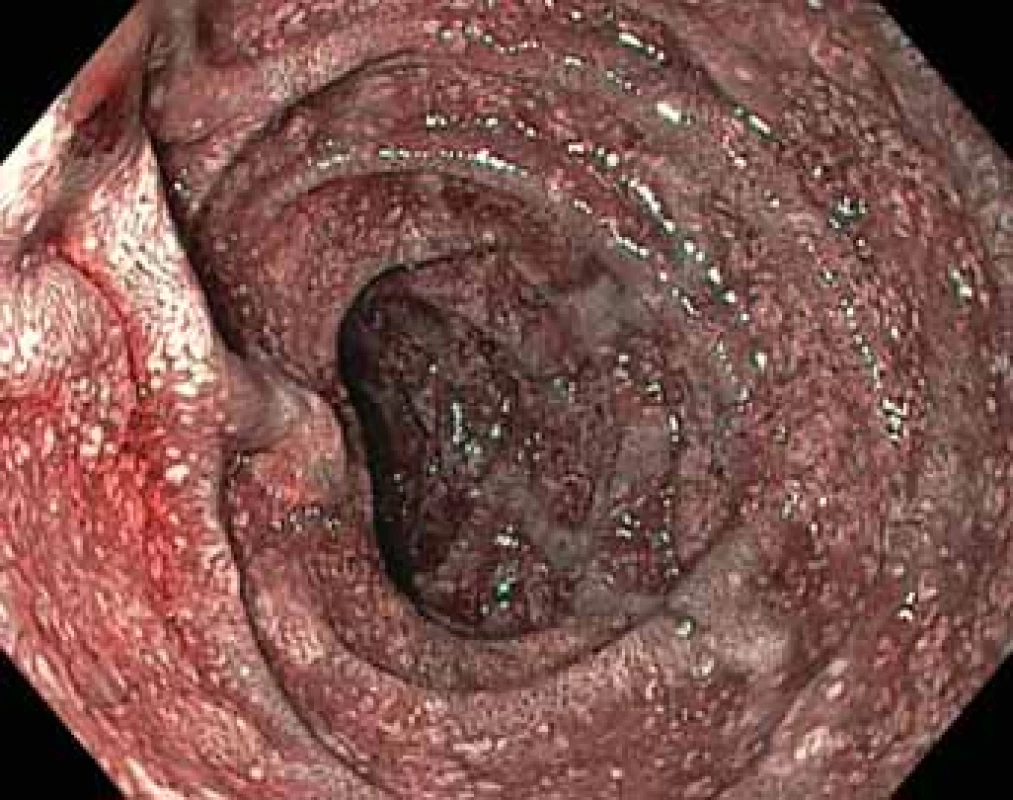 Postpublární část duodena – vstupní NBI (narrow band imaging) endoskopie.<br>
Postbulbar part of duodenum – initial NBI (Narrow Band Imaging) endoscopy.
