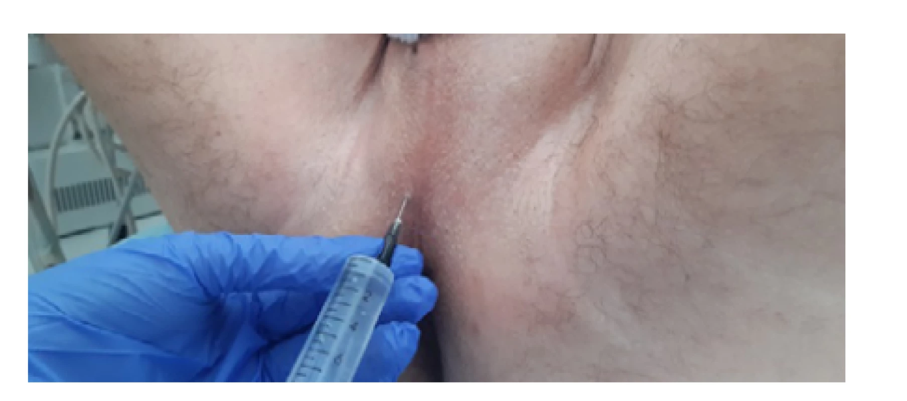Lokální anestezie oblasti hráze (archiv autora)<br>
Fig. 7. Local anesthesia of the perineum (author’s
archive)