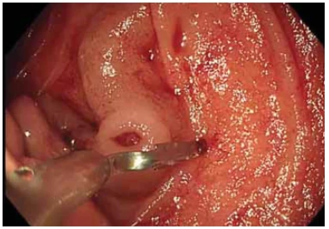 Krvácející defekt duodenálního varixu, nasazení klipu
„Boston Ultra“. <br> 
Fig. 3. Bleeding duodenal varix defect, deployment of “Boston
Ultra” clip.
