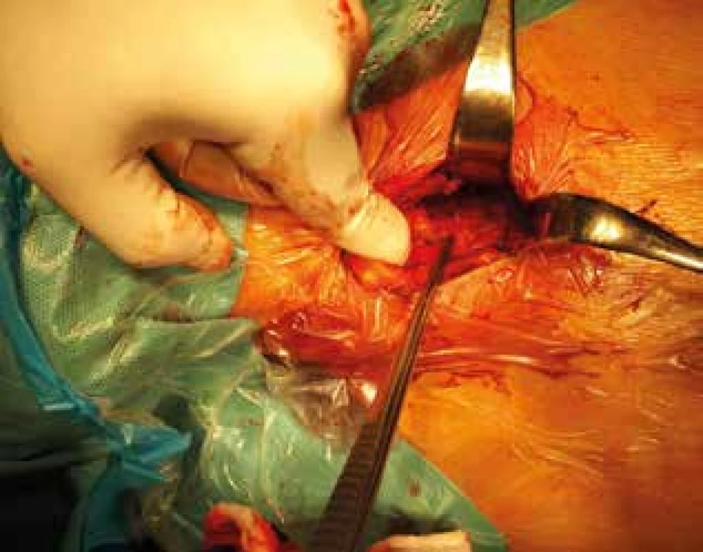 Krčná fáza, priebeh n.laryngeus recurrens l.dx <br>
Fig. 2: Cervical phase, dissection of right laryngeal recurrent nerve