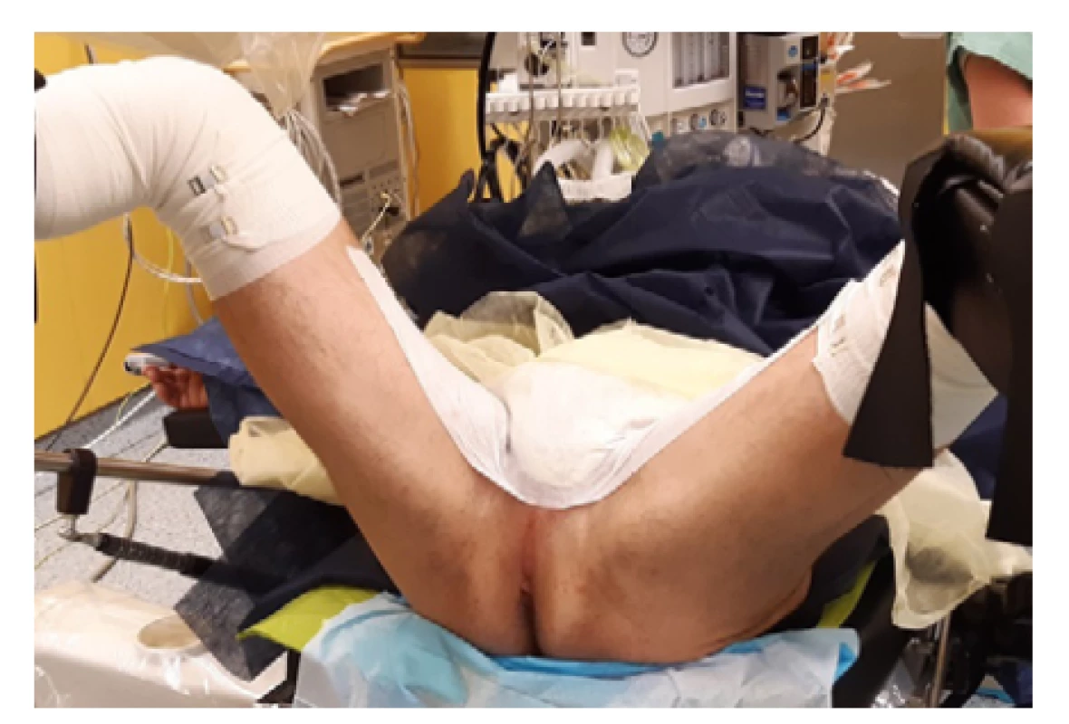 Poloha pacienta při TPBxP (archiv autora)<br>
Fig. 1. Patient position during TPBxP (author’s archive)