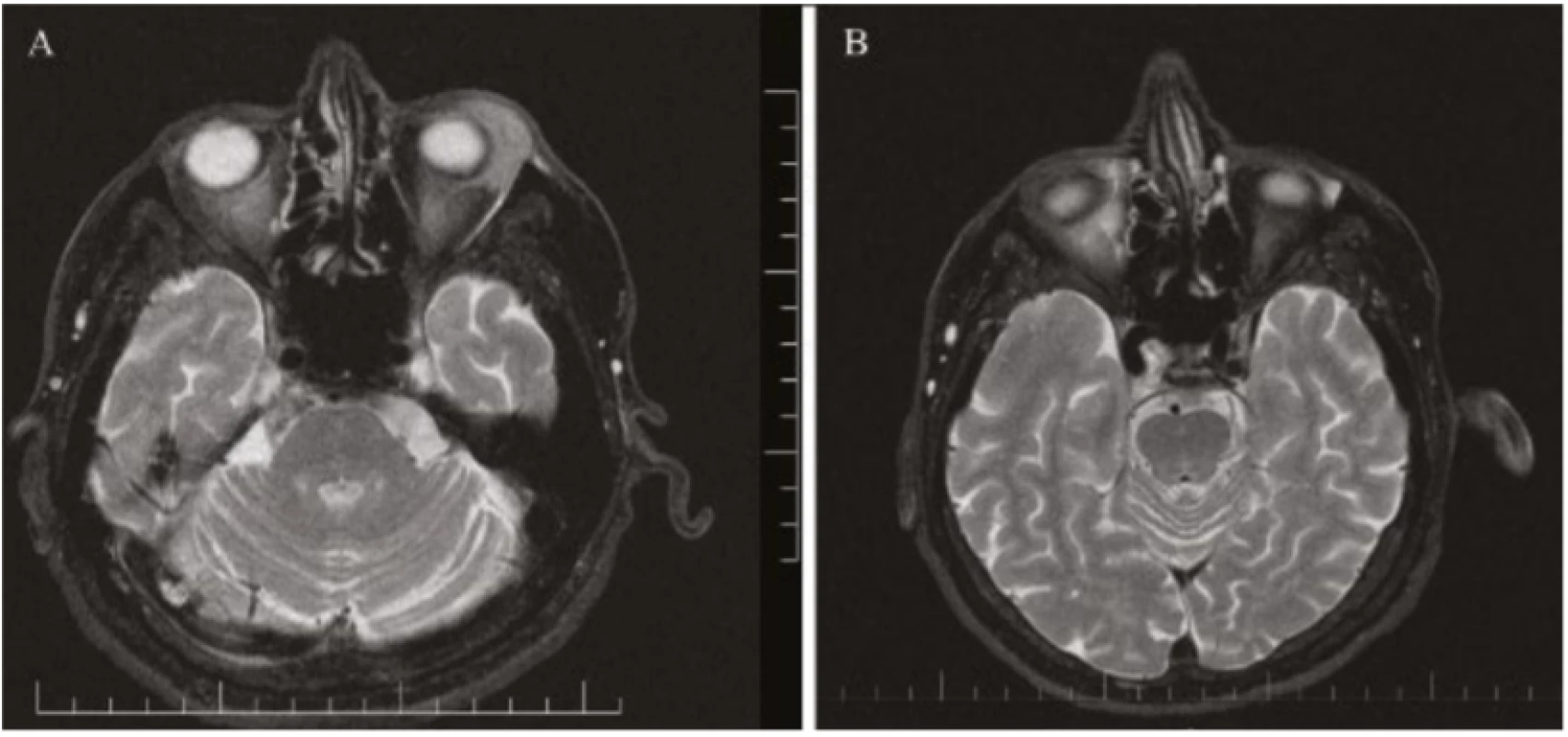 Fig. 5. Patient 2 – magnetic resonance of head: axial cross-section, T2 weighting, lymphoma of lower
left eyelid<br>
A) at time of diagnosis 01/2019<br>
B) following chemotherapy and immunological treatment 11/2019