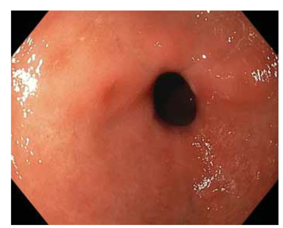  Vysokorozlišovací endoskopie, zobrazení v bílém
světle. Žaludeční antrum, endoskopický obraz nespecifické 
difuzní erytematózní gastropatie.<br>
Fig. 1. High-resolution white light endoscopy. Gastric antrum,
endoscopic image of nonspecific diffuse erythematous
gastropathy.