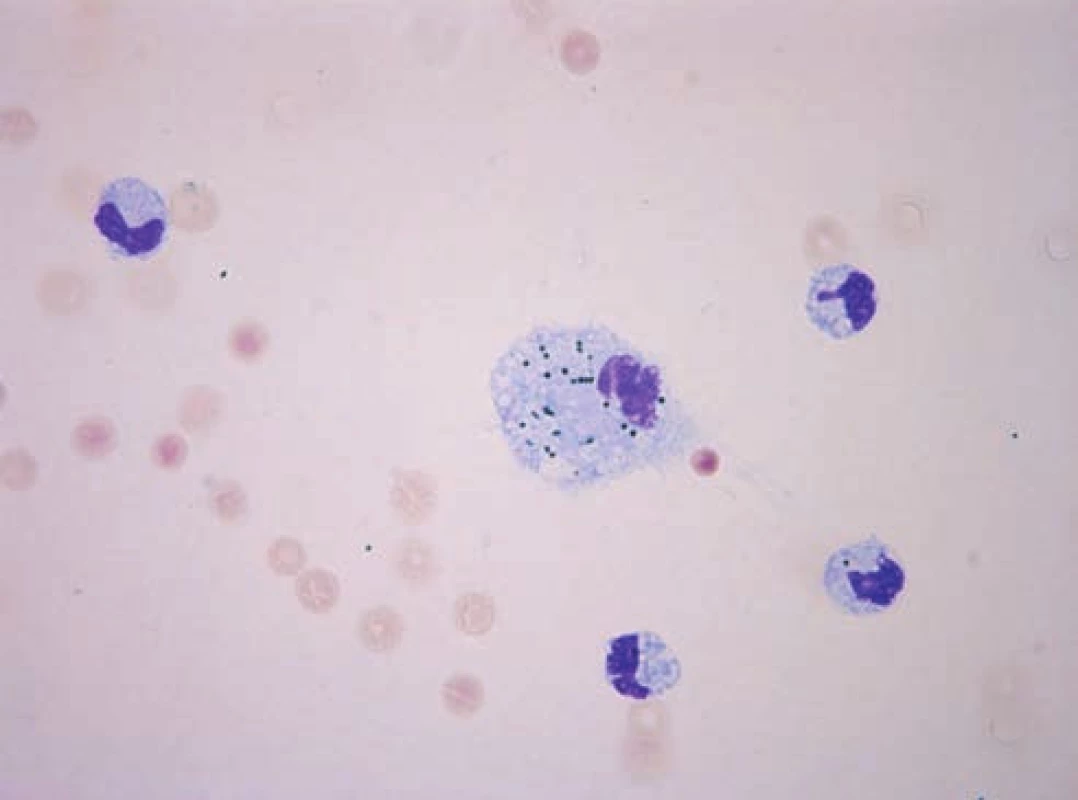 Qualitative cytological examination of anterior chamber fluid of left eye – swab on glass, staining Hemacolor Rapid Staining, Merck, enlargement 63x: admixture of erythrocytes, monocytes and pigmentophages with granules – monocytic pleocytosis
