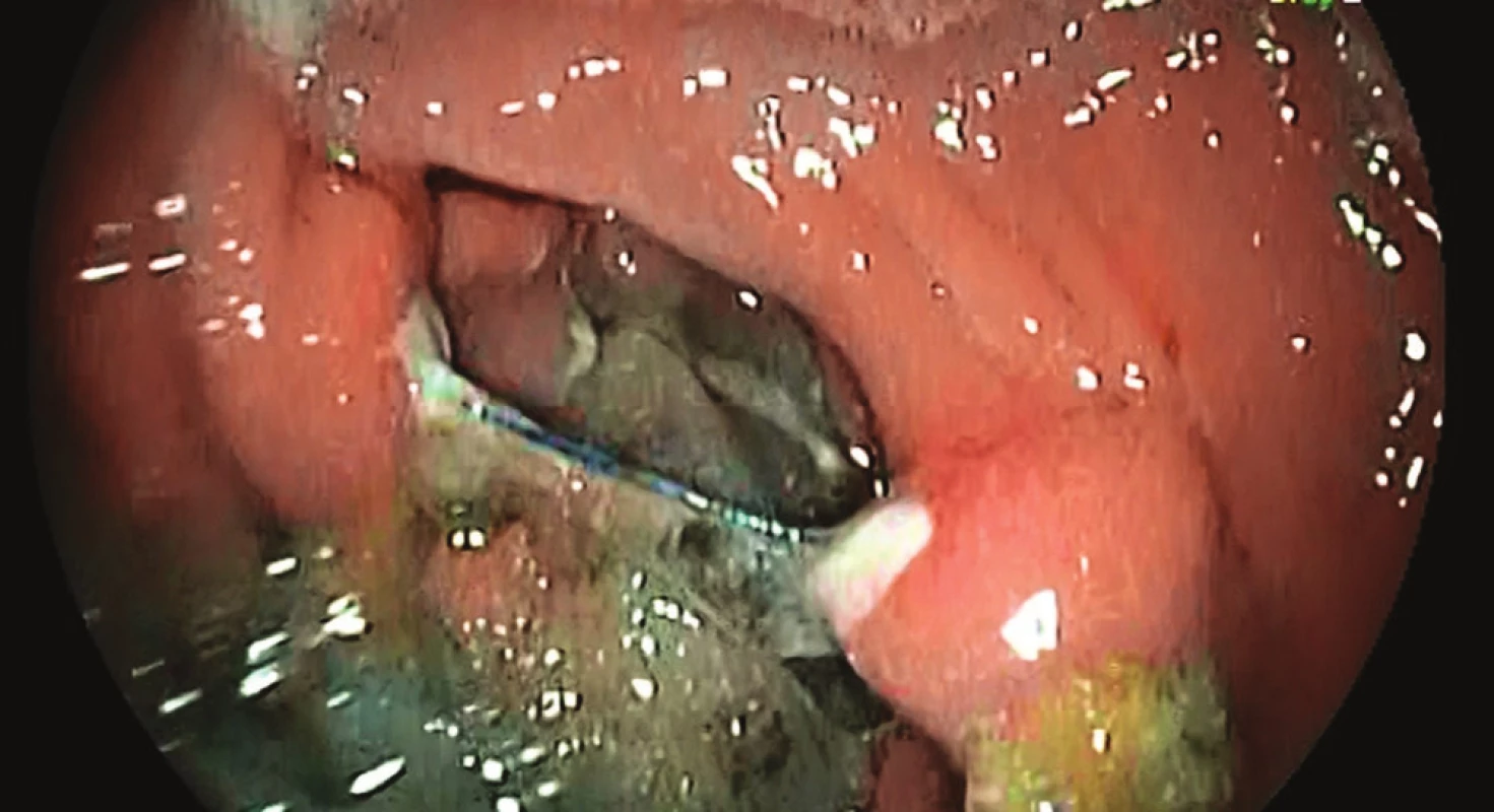 Gastroskopie po LGCP s nálezem divertiklu v horní
polovině zahrnuté linie plikace<br>
Fig. 2: Gastroscopy after gastric plication with finding of
diverticulum during plication